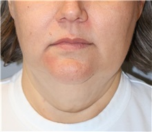 Liposuction Before Photo by Ellen Mahony, MD; Westport, CT - Case 51089