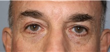 Eyelid Surgery After Photo by Ellen Mahony, MD; Westport, CT - Case 51087
