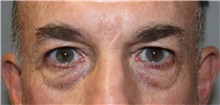 Eyelid Surgery Before Photo by Ellen Mahony, MD; Westport, CT - Case 51087