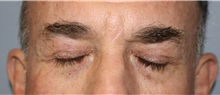 Eyelid Surgery After Photo by Ellen Mahony, MD; Westport, CT - Case 51087