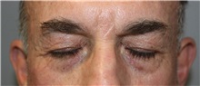 Eyelid Surgery Before Photo by Ellen Mahony, MD; Westport, CT - Case 51087