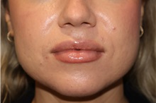 Injectable Fillers and Fat Transfer to the Face After Photo by Ellen Mahony, MD; Westport, CT - Case 51090