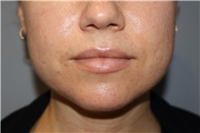 Injectable Fillers and Fat Transfer to the Face Before Photo by Ellen Mahony, MD; Westport, CT - Case 51090