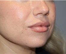 Injectable Fillers and Fat Transfer to the Face After Photo by Ellen Mahony, MD; Westport, CT - Case 51090