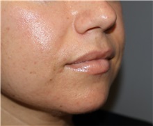 Injectable Fillers and Fat Transfer to the Face Before Photo by Ellen Mahony, MD; Westport, CT - Case 51090