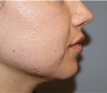 Injectable Fillers and Fat Transfer to the Face After Photo by Ellen Mahony, MD; Westport, CT - Case 51090