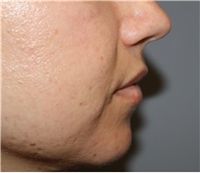 Injectable Fillers and Fat Transfer to the Face Before Photo by Ellen Mahony, MD; Westport, CT - Case 51090