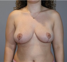 Breast Reduction After Photo by Ellen Mahony, MD; Westport, CT - Case 51091