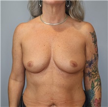 Breast Augmentation Before Photo by Ellen Mahony, MD; Westport, CT - Case 51297