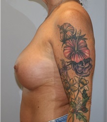 Breast Augmentation After Photo by Ellen Mahony, MD; Westport, CT - Case 51297
