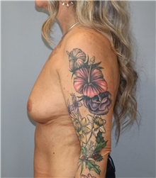 Breast Augmentation Before Photo by Ellen Mahony, MD; Westport, CT - Case 51297