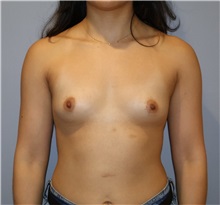 Breast Augmentation Before Photo by Ellen Mahony, MD; Westport, CT - Case 51299
