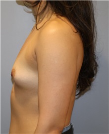 Breast Augmentation Before Photo by Ellen Mahony, MD; Westport, CT - Case 51299