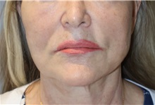 Thread Lift After Photo by Ellen Mahony, MD; Westport, CT - Case 51301