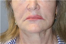Thread Lift Before Photo by Ellen Mahony, MD; Westport, CT - Case 51301