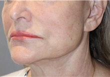 Thread Lift After Photo by Ellen Mahony, MD; Westport, CT - Case 51301