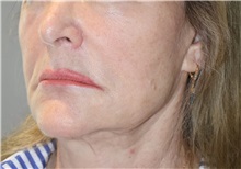 Thread Lift Before Photo by Ellen Mahony, MD; Westport, CT - Case 51301