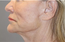 Thread Lift After Photo by Ellen Mahony, MD; Westport, CT - Case 51301