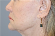 Thread Lift Before Photo by Ellen Mahony, MD; Westport, CT - Case 51301
