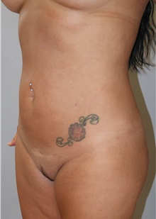 Liposuction After Photo by Ellen Mahony, MD; Westport, CT - Case 51302