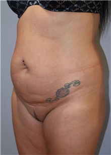 Liposuction Before Photo by Ellen Mahony, MD; Westport, CT - Case 51302