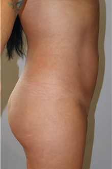 Liposuction After Photo by Ellen Mahony, MD; Westport, CT - Case 51302