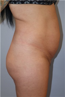Liposuction Before Photo by Ellen Mahony, MD; Westport, CT - Case 51302
