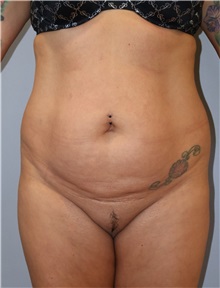 Liposuction Before Photo by Ellen Mahony, MD; Westport, CT - Case 51302