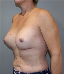 Breast Augmentation Before Photo by Ellen Mahony, MD; Westport, CT - Case 51541