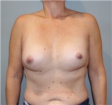 Breast Augmentation Before Photo by Ellen Mahony, MD; Westport, CT - Case 51541
