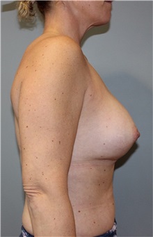 Breast Augmentation Before Photo by Ellen Mahony, MD; Westport, CT - Case 51541