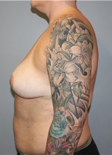 Breast Reduction After Photo by Ellen Mahony, MD; Westport, CT - Case 51548