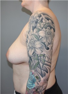 Breast Reduction Before Photo by Ellen Mahony, MD; Westport, CT - Case 51548