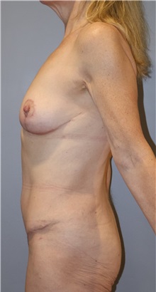 Mommy Makeover After Photo by Ellen Mahony, MD; Westport, CT - Case 51546
