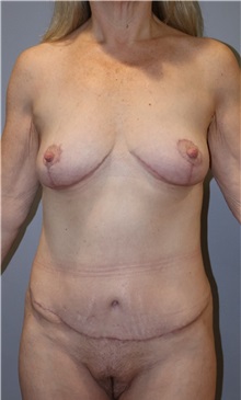 Mommy Makeover After Photo by Ellen Mahony, MD; Westport, CT - Case 51546