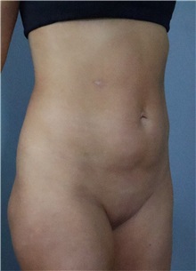 Liposuction Before Photo by Ellen Mahony, MD; Westport, CT - Case 51545