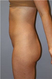 Liposuction After Photo by Ellen Mahony, MD; Westport, CT - Case 51545