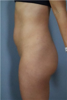 Liposuction Before Photo by Ellen Mahony, MD; Westport, CT - Case 51545