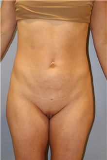 Liposuction After Photo by Ellen Mahony, MD; Westport, CT - Case 51545