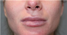 Lip Augmentation/Enhancement Before Photo by Ellen Mahony, MD; Westport, CT - Case 49336
