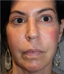 Dermal Fillers After Photo by Ellen Mahony, MD; Westport, CT - Case 49332