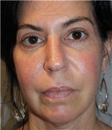 Dermal Fillers Before Photo by Ellen Mahony, MD; Westport, CT - Case 49332