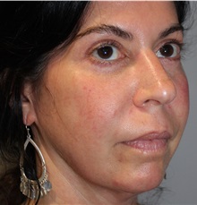 Dermal Fillers After Photo by Ellen Mahony, MD; Westport, CT - Case 49332