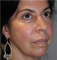 Dermal Fillers Before Photo by Ellen Mahony, MD; Westport, CT - Case 49332