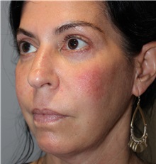 Dermal Fillers After Photo by Ellen Mahony, MD; Westport, CT - Case 49332