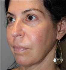 Dermal Fillers Before Photo by Ellen Mahony, MD; Westport, CT - Case 49332