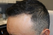 Hair Transplant After Photo by Ellen Mahony, MD; Westport, CT - Case 49633