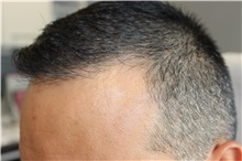 Hair Transplant Before Photo by Ellen Mahony, MD; Westport, CT - Case 49633