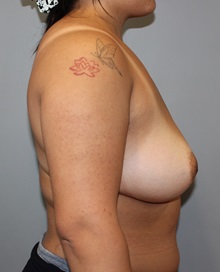 Breast Reduction Before Photo by Ellen Mahony, MD; Westport, CT - Case 49630