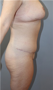 Tummy Tuck After Photo by Ellen Mahony, MD; Westport, CT - Case 49920 Tummy Tuck After Photo by Ellen Mahony, MD; Westport, CT - Case 49920